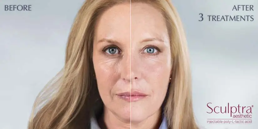 Sculptra in Louisville