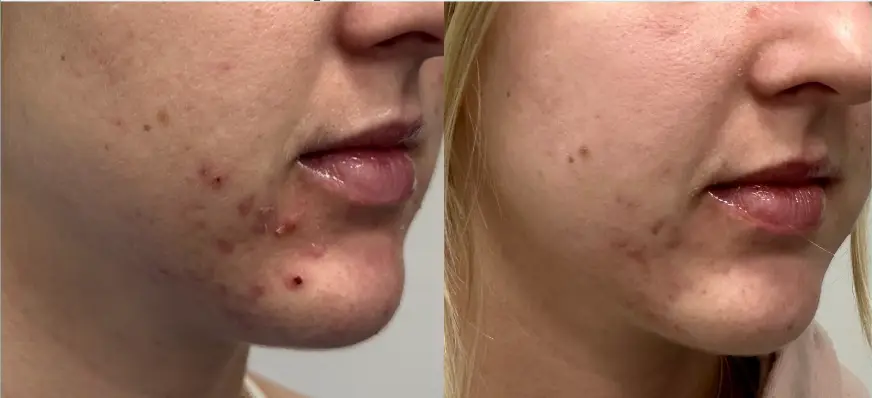 Before Acne Treatment at Vibrant Medical Spa