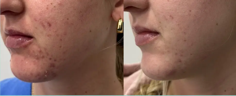 After Acne Treatment at Vibrant Medical Spa