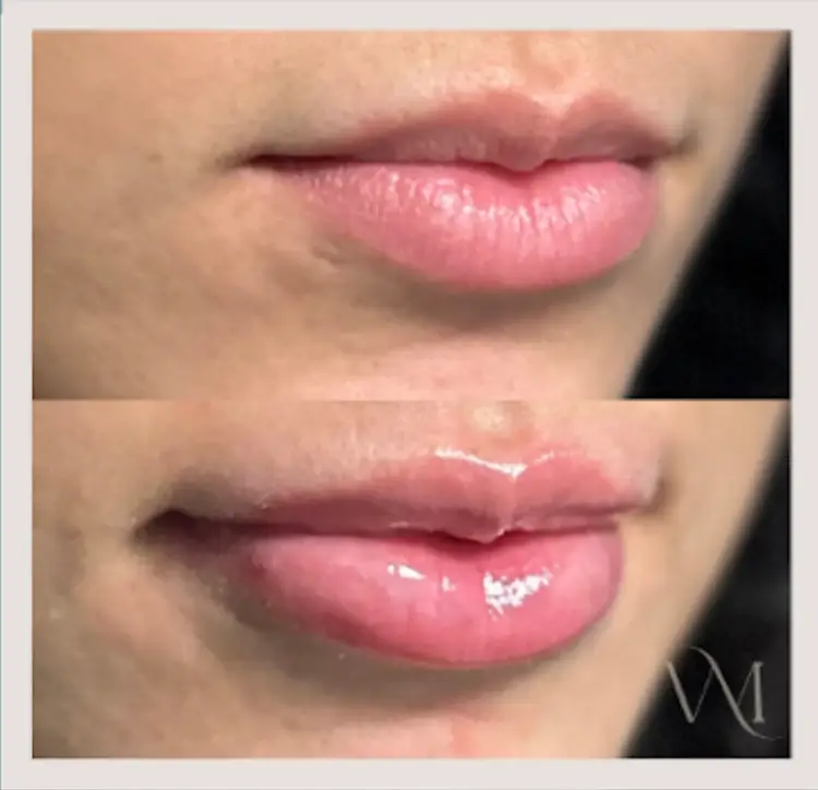 Louisville med spa services. 1/2 syringe of lip filler before and after.