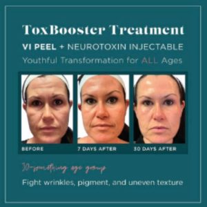 Image of Botox Booster Treatment for Vibrant Med Spa in Louisville