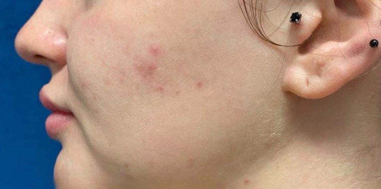 HydraFacial